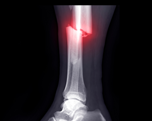 Fracture Surgery